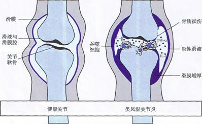 類風(fēng)濕關(guān)節(jié)炎檢測(cè) 項(xiàng)目更齊全